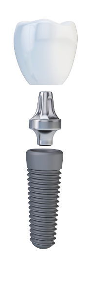 Implant Tooth